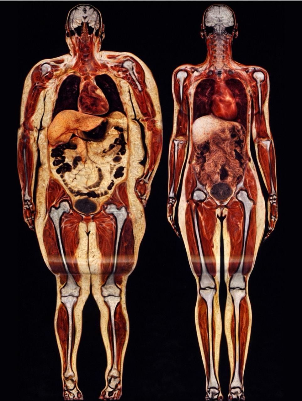 Зайва вага вбиває